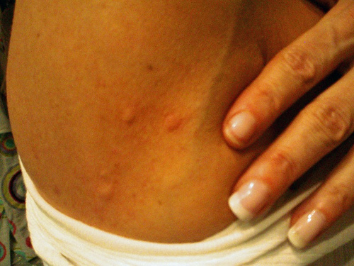 Bed bug bites photos ~ The Bed Bug Exterminators