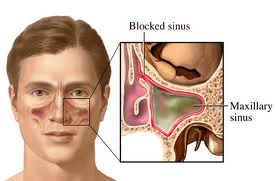 obat tradisional sinusitis