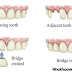 Quy trình bọc răng sứ thẩm mỹ chuẩn an toàn cho bạn