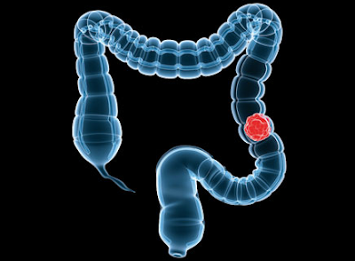 How is colon cancer stage 4 treatment.