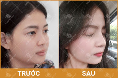 nâng mũi bọc sụn vĩnh viễn không