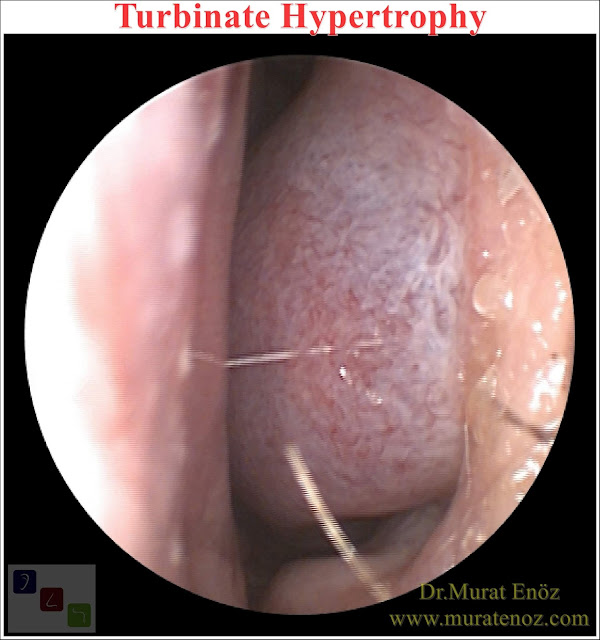 Turbinate Hypertrophy