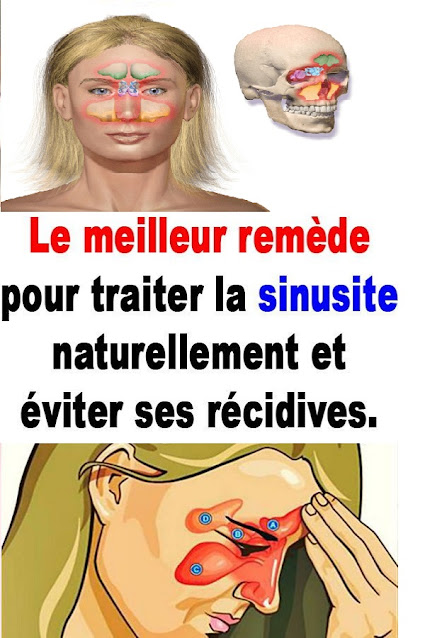 Traiter-une-sinusite-naturellement