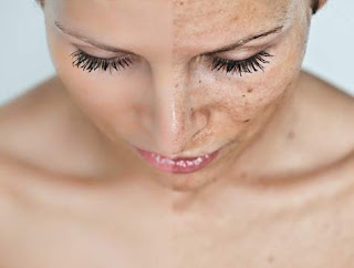 como combatir el acne, combatir el acne