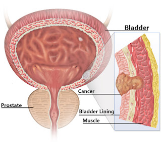 Bladder Cancer - Symptoms And Treatment