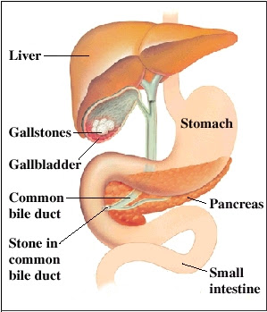 acute pancreatitis