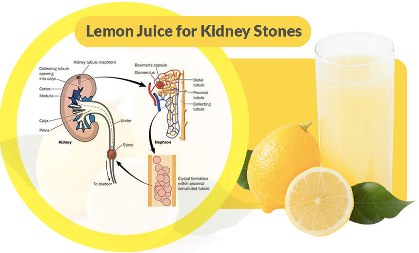 Here's How To Use Lemon To Fight Kidney Stones: Prevention Is Better Than Cure: