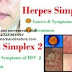 Cara Menghilangkan Herpes Pada Tangan