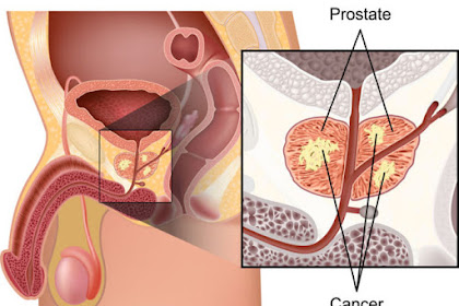 Do I Have Prostate Cancer? 12 Early Symptoms Men Should Never Ignore