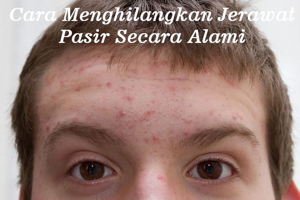 Cara Menghilangkan Jerawat Pasir secara alami