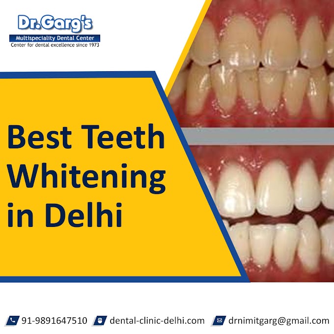 Best Teeth Whitening in Delhi