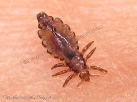 Head Lice Picture