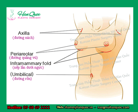 Nâng ngực nội soi túi Natrelle Inspira công nghệ mới 3