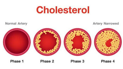 Mari Belajar Memahami Kolesterol Dalam Tubuh