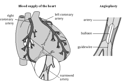 Health Problem &amp; Solutions: Angina Pectoris