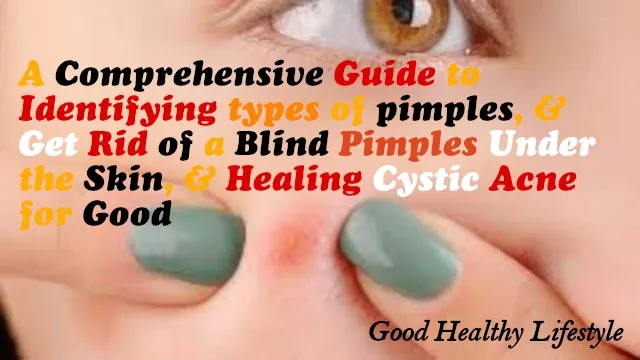 Get rid of blind pimples, acne, cystic acne & pimples under the skin