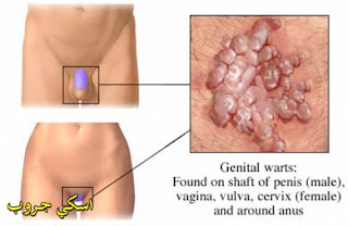 علاج الثالول - الثاليل - الثؤلول - الثآليل - الجزء الثانى Wart treatment