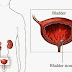 Bladder stones SYMPTOMS, CAUSES, RISK FACTORS, COMPLICATIONS, TREATMENTS and medicines