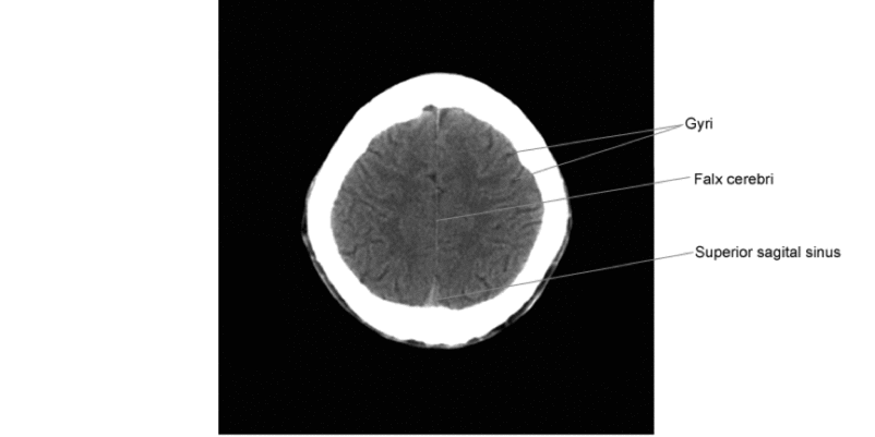 CT-Scan kepala