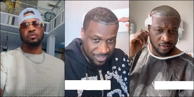 Peter Okoye Of PSqaure Undergoes Hair Transplant In Instanbul.