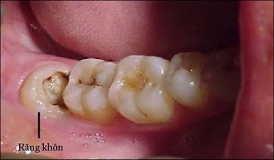 Răng khôn bị sâu có nên nhổ không? Bác sĩ giải đáp 1