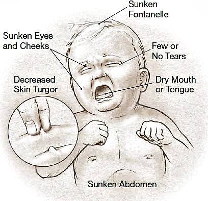 APA ITU JANGKITAN ROTAVIRUS?  SIMPTOM & CARA MENGATASI 