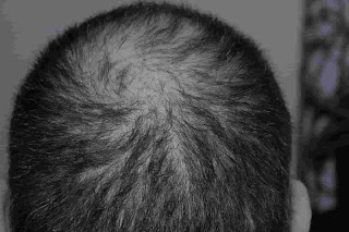 How I can stop my hair loss