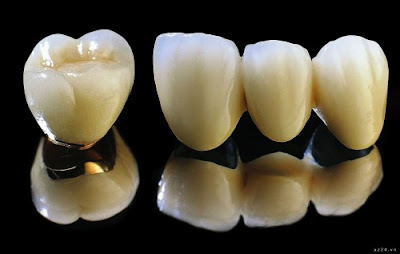 Cấu tạo của răng sứ Cercon – Zirconia