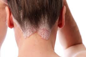 Psoriasis is a skin disease that  causes scaling and inflammation