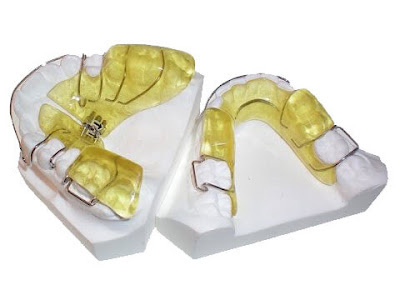 Phương pháp nong xương hàm khi niềng răng