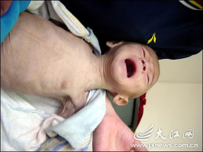 Baby with old man's skin