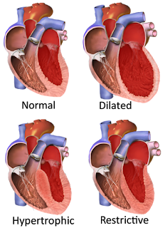 kardiomiopati restriktif hipertrofik dilatasi kavitas ventrikel miokardium amiloidosis perikarditis 