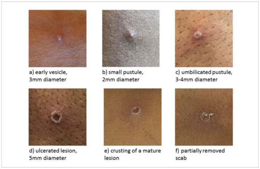 भारत में पाये गये मंकी पॉक्स के मामले.जानिये क्या है यह बिमारी.Cases of Monkey Pox found in India.Know what is this disease.monkeypox,Fast News,HINDI News,hindi news blog,मंकीपॉक्स