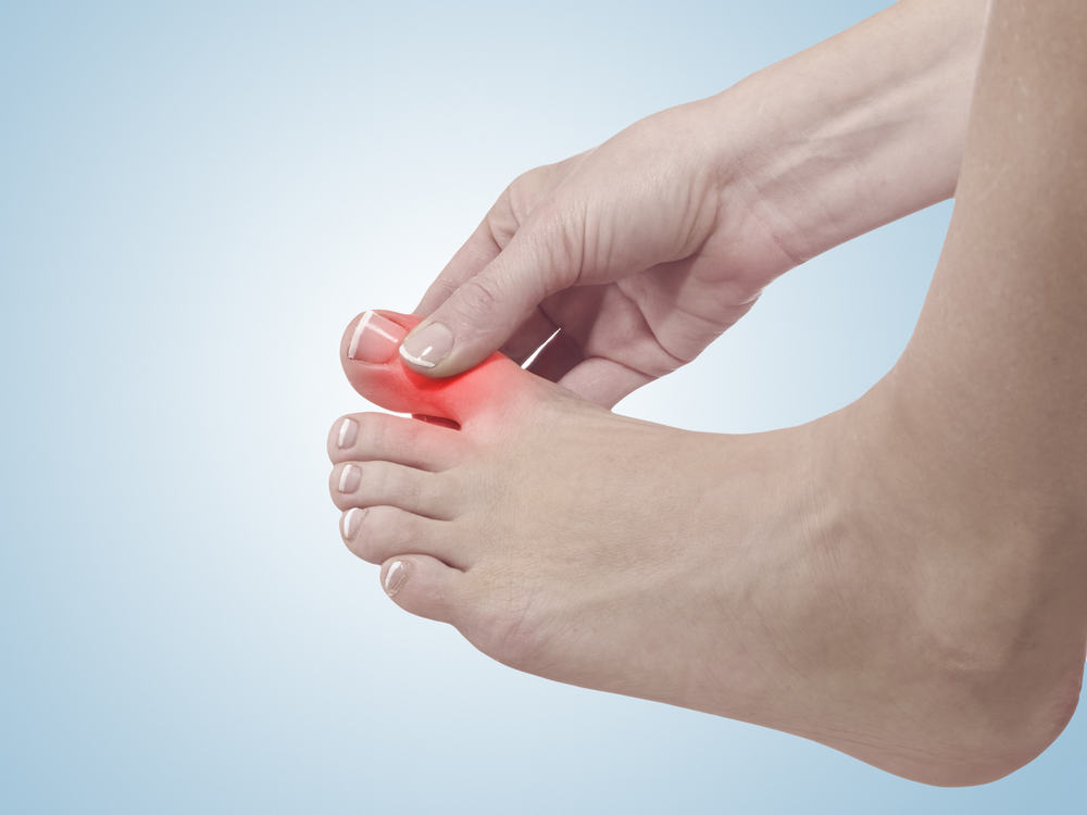 How to relieve severe pain caused by gout