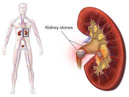 Kedney stones self care | mutkhada se bachav 