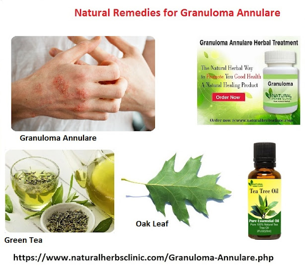 Natural Remedies for Granuloma Annulare