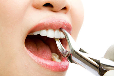  Nhổ răng an toàn tại nha khoa Đăng Lưu