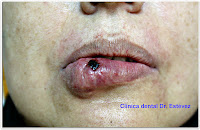 Angioma labial clínica dental dr. Estevez