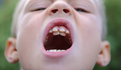 Xử lý răng mọc trong vòm miệng gây khó chịu-2