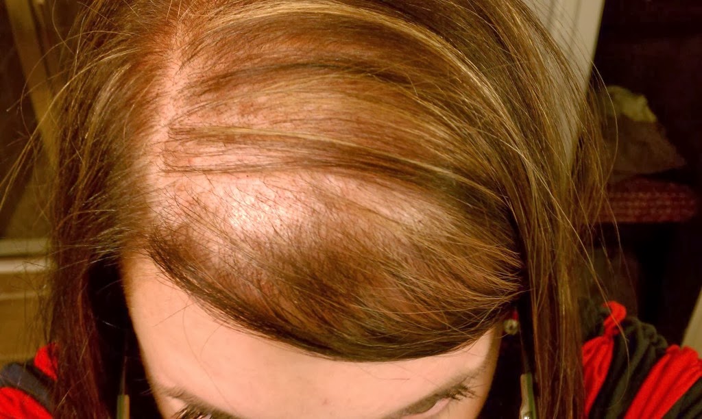 Female Hair Loss Is On The Rise - Top and Trend Hairstyle