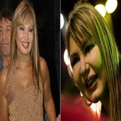 fotos-de-famosas-que-ja-fizeram-botox