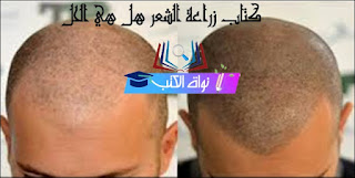 كتاب زراعة الشعر هل هي الحل