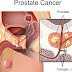 Stages of Prostate Cancer - Survival Rates.