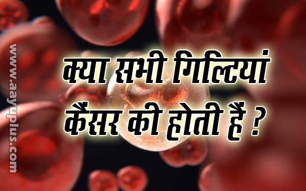 क्या सभी गिल्टियां कैंसर की होती हैं..? ( Are there all stones of Cancer?)