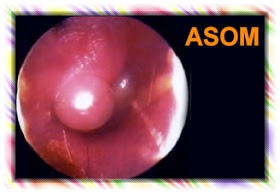 ASOM