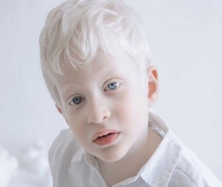 Albinism disease | Diseasezero