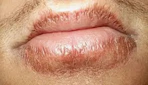 dry lips. A man's lips are dehydrated