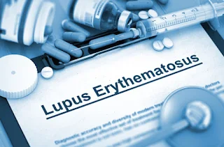 LES (lupus Eritematosus Sistemik)