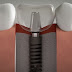 Công nghệ vượt trội của cấy ghép Implant