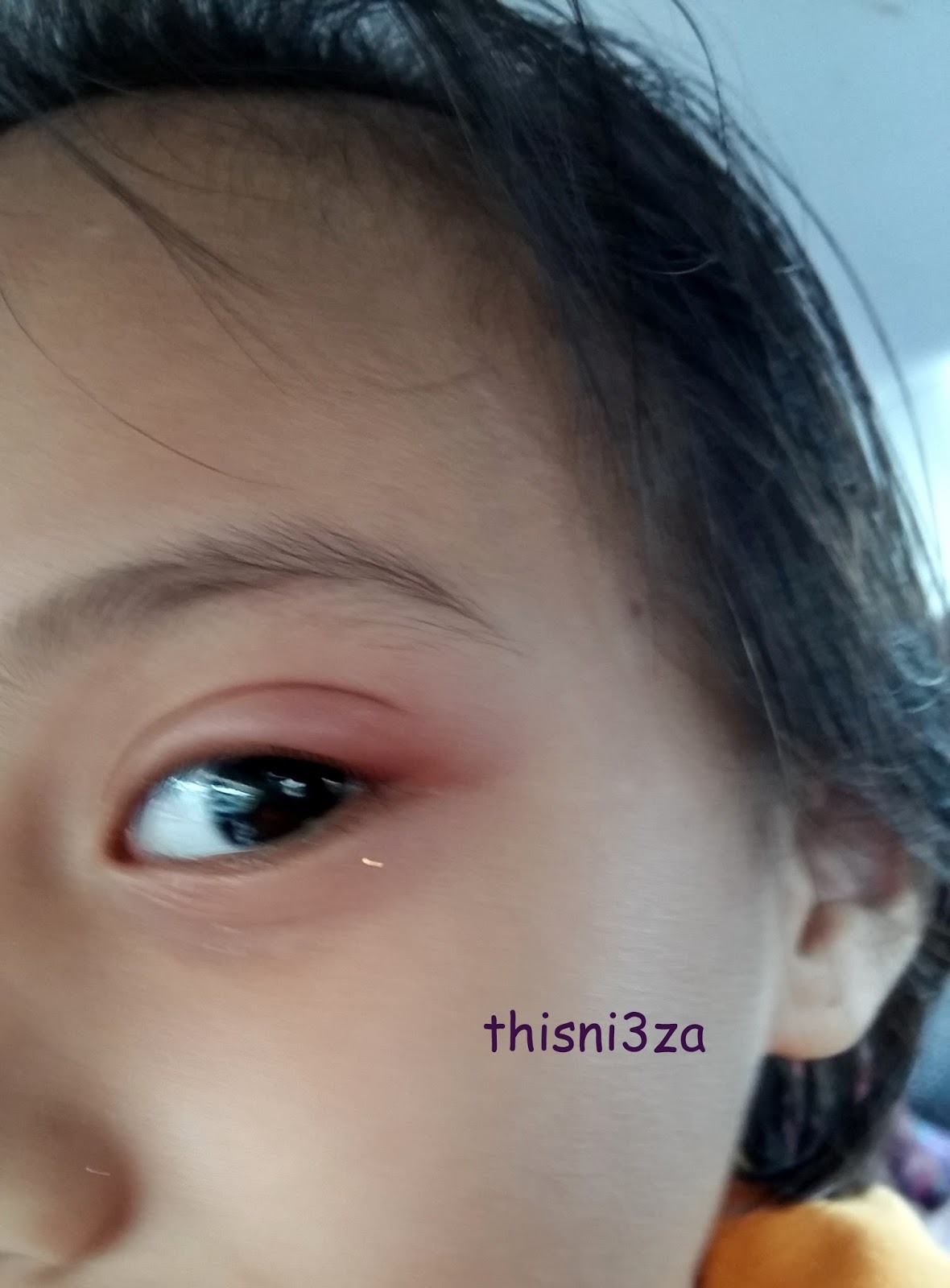 Kisah Qaisara : Eye Infection ~ My Story Board